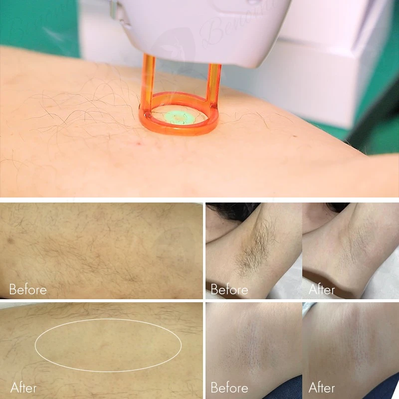 treatment effect treatment effect